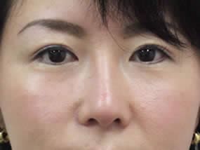 目の下のクマ・タルミ症例手術２週間後（メイクあり）
