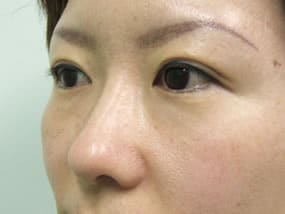 目の下のクマ・タルミ症例手術前