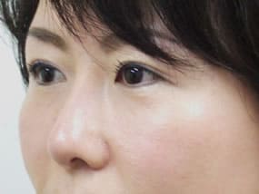目の下のクマ・タルミ症例手術３ヶ月後