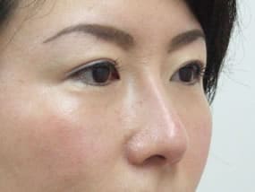 目の下のクマ・タルミ症例手術３ヶ月後