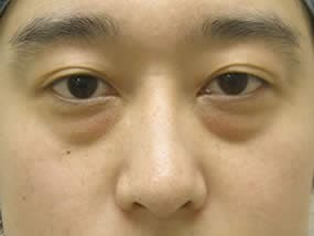 目の下のクマ・タルミ症例手術前