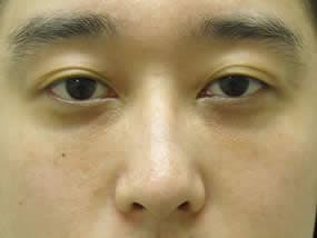目の下のクマ・タルミ症例手術２週間後