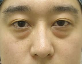 目の下のクマ・タルミ症例手術前