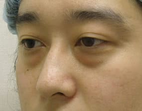 目の下のクマ・タルミ症例手術前
