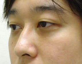 目の下のクマ・タルミ症例手術３ヶ月後