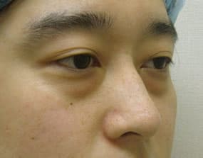 目の下のクマ・タルミ症例手術前