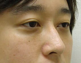 目の下のクマ・タルミ症例手術３ヶ月後