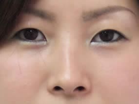 目の下のクマ・タルミ症例手術３ヶ月後
