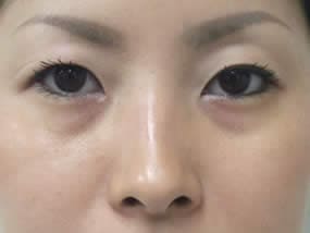 目の下のクマ・タルミ症例手術前（メイクあり）