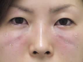目の下のクマ・タルミ症例手術直後（メイクなし）