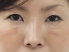 目の下のクマ・タルミ症例手術２日後（メイクあり）