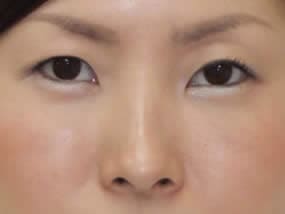 目の下のクマ・タルミ症例手術１週間後（メイクあり）