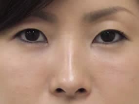 目の下のクマ・タルミ症例手術２週間後（メイクあり）