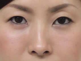 目の下のクマ・タルミ症例手術１ヵ月後（メイクあり）