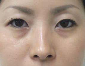 目の下のクマ・タルミ症例手術前