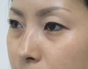 目の下のクマ・タルミ症例手術前