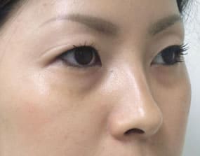 目の下のクマ・タルミ症例手術前