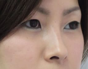 目の下のクマ・タルミ症例手術３ヶ月後