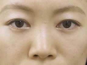 目の下のクマ・タルミ症例手術３ヶ月後