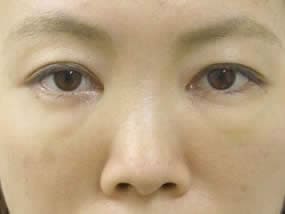 目の下のクマ・タルミ症例手術１週間後（メイクあり）