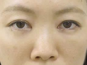 目の下のクマ・タルミ症例手術２週間後（メイクあり）