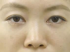 目の下のクマ・タルミ症例手術１ヵ月後（メイクあり）