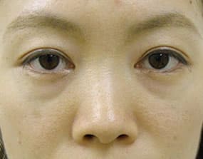 目の下のクマ・タルミ症例手術前