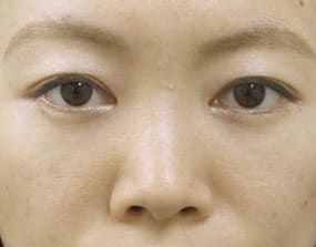 目の下のクマ・タルミ症例手術３ヶ月後