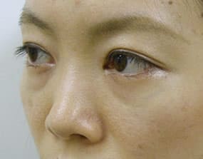 目の下のクマ・タルミ症例手術前