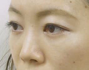 目の下のクマ・タルミ症例手術３ヶ月後