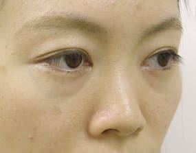 目の下のクマ・タルミ症例手術前