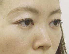 目の下のクマ・タルミ症例手術３ヶ月後