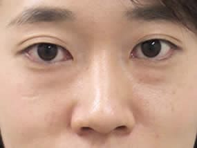 目の下のクマ・タルミ症例手術前（メイクあり）