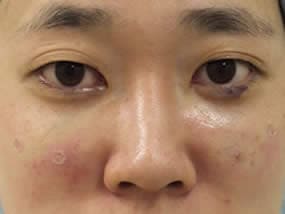 目の下のクマ・タルミ症例手術直後（メイクなし）
