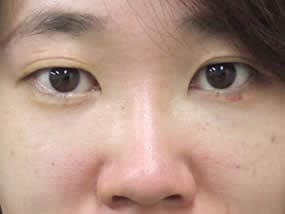 目の下のクマ・タルミ症例手術１週間後（メイクあり）
