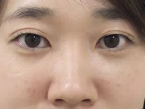 目の下のクマ・タルミ症例手術２週間後（メイクあり）