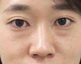 目の下のクマ・タルミ症例手術前