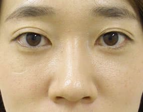 目の下のクマ・タルミ症例手術３ヶ月後
