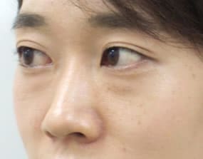 目の下のクマ・タルミ症例手術前