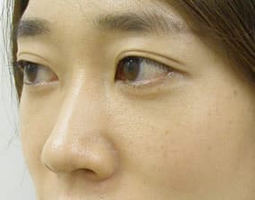 目の下のクマ・タルミ症例手術３ヶ月後