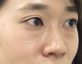目の下のクマ・タルミ症例手術前