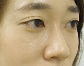 目の下のクマ・タルミ症例手術３ヶ月後