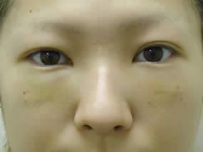 目の下のクマ・タルミ症例手術直後（メイクなし）