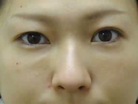 目の下のクマ・タルミ症例手術１週間後（メイクあり）