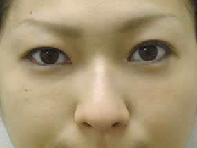 目の下のクマ・タルミ症例手術２週間後（メイクあり）