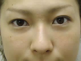 目の下のクマ・タルミ症例手術１ヵ月後（メイクあり）