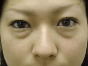 目の下のクマ・タルミ症例手術前