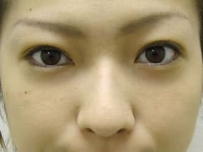 目の下のクマ・タルミ症例手術３ヶ月後