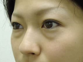 目の下のクマ・タルミ症例手術前