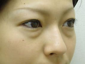 目の下のクマ・タルミ症例手術前